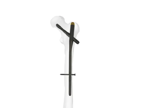 Long Proximal Femoral Nails Anti-Rotation, Seceda&trade; Pfna Intramedullary Nail System, Titanium Orthopedic Surgical Implant for Trauma Surgery, with CE&ISO